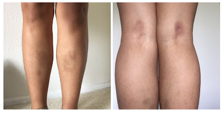 leg bruises