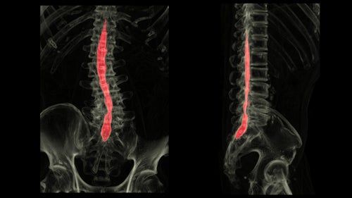 Myelogram
