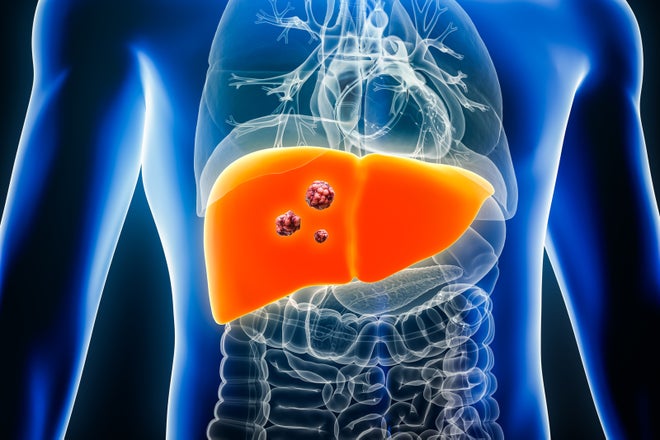 Liver Cancer