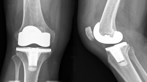 OMNIBotics Total Knee Replacement