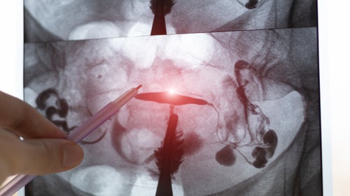 Cystogram