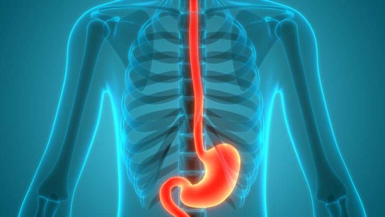 Esophageal Cancer